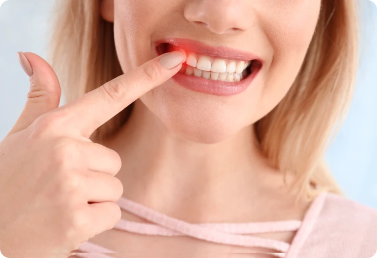 Patiente montrant sa gencive inflammée