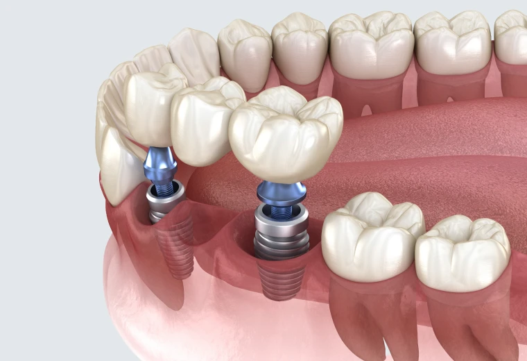 Schéma d'un bridge dentaire soutenu par deux implants entre des dents naturelles