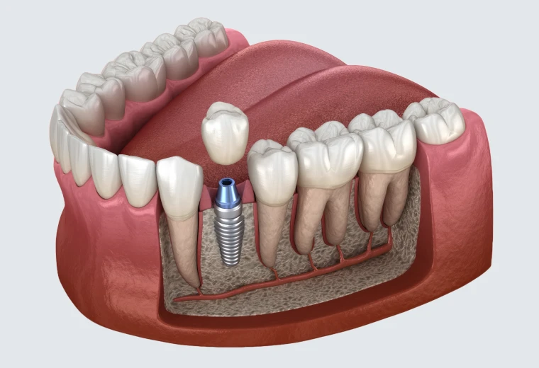 Coupe anatomique d'un implant dentaire unitaire intégré dans l'os avec sa couronne