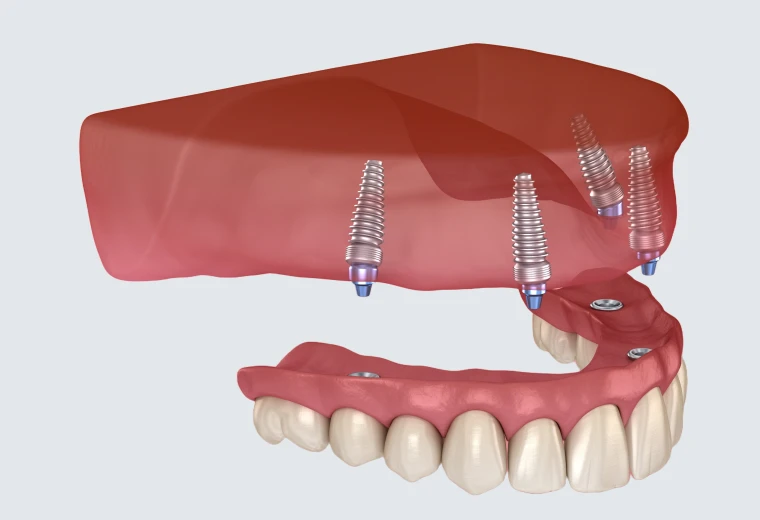 Schéma de la répartition d'implants inclinés soutenant une prothèse complète sur une arcade